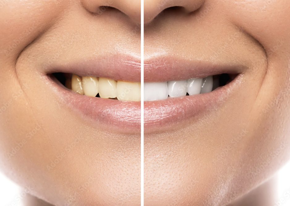 "The image shows a side-by-side comparison of teeth before and after whitening treatment. The before image, on the left side, displays yellow and discolored teeth, while the after image, on the right side, shows bright and shining teeth. This image illustrates the dramatic difference that teeth whitening treatment can make to the color of the teeth, resulting in a more vibrant and attractive smile."