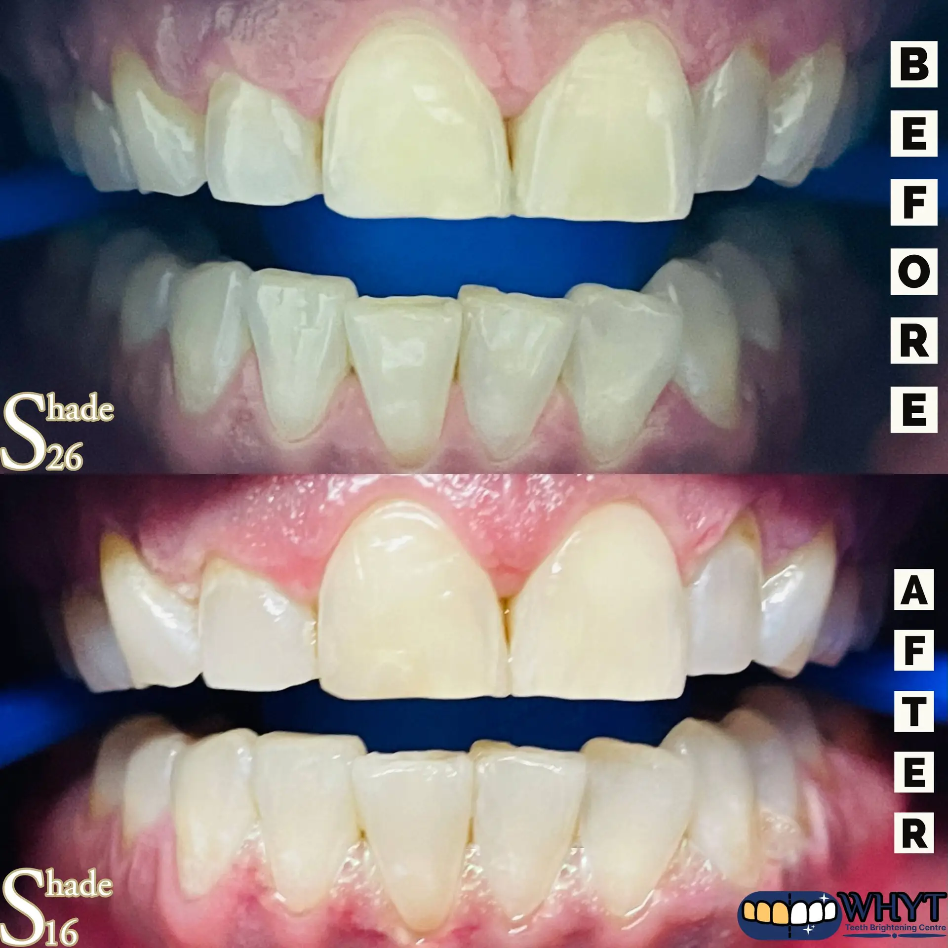 "Before and after teeth whitening image: The image shows a collage of two pictures side by side. On the top, there's a picture of yellowish teeth, and on the bottom, there's a picture of white, sparkling teeth. This image illustrates the results of teeth whitening treatment and highlights the improvement in tooth color."